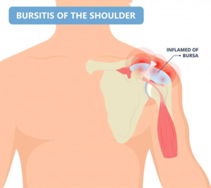 Bursitis di bahu