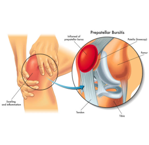 Bursitis pada lutut